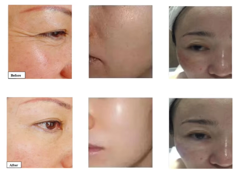 Oxygen Hydra Dermabrasion Skin Cleaning Machine 17