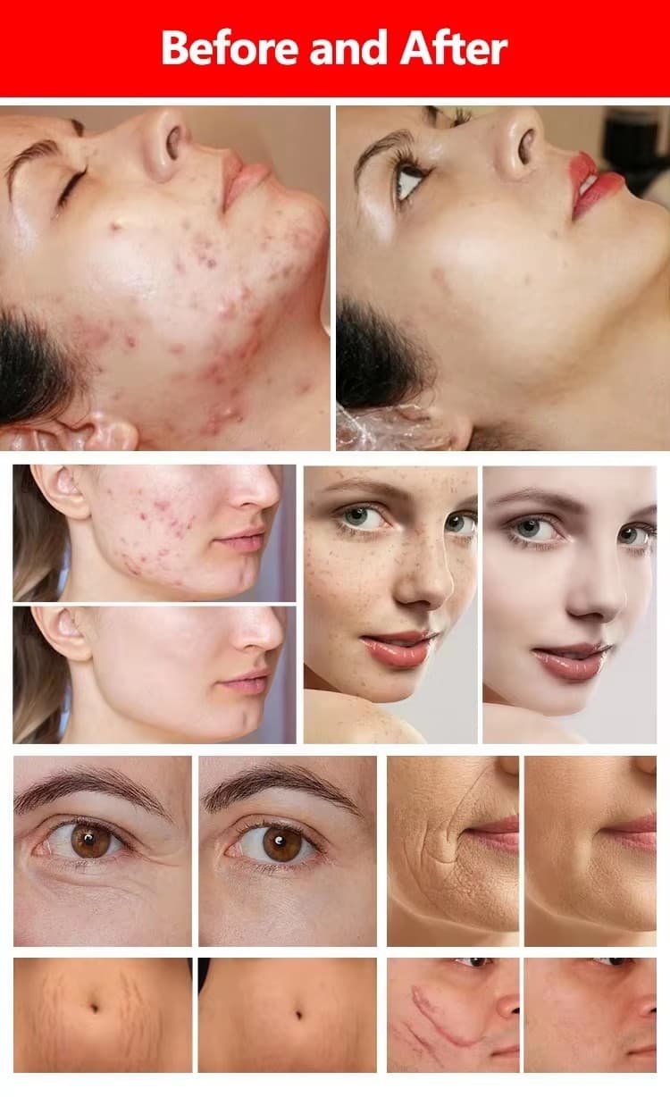 60w Co2 Fractional Laser 19